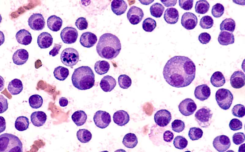 Bone marrow aspirate cytology of multiple myeloma