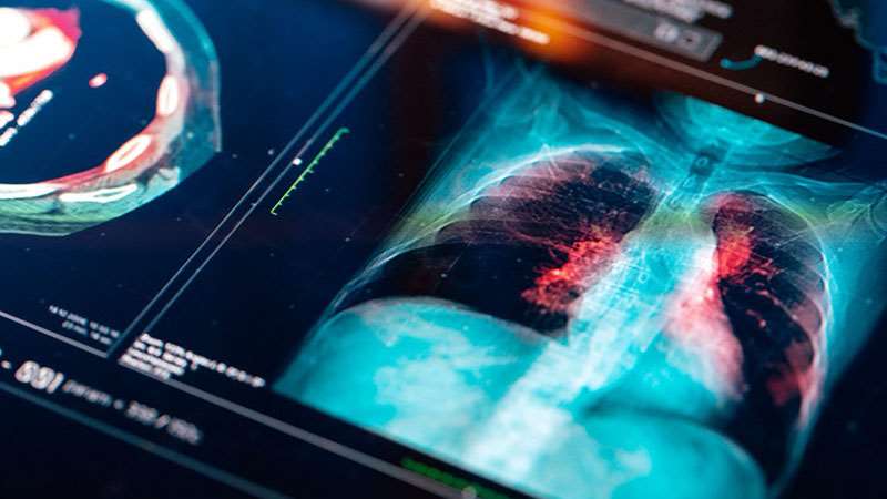 Cancer Metabolism